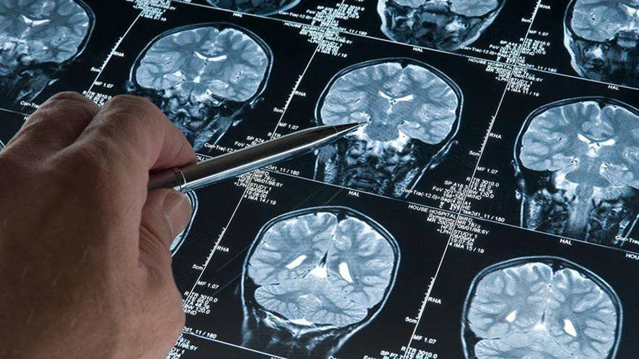 Araştırma: Derin uyku Alzheimer hastalığını yavaşlatıyor Araştırma: Derin uyku Alzheimer hastalığını yavaşlatıyor