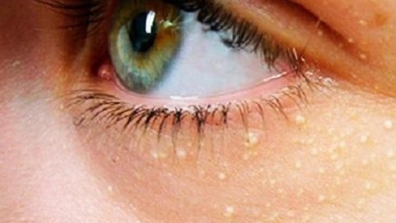 Yüzdeki sarı lekeler kalp krizi ve inme riskini artırıyor: Ksantalazma uyarısı